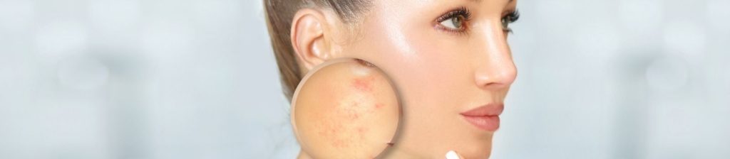 Tratamento de Cicatrizes de Acne