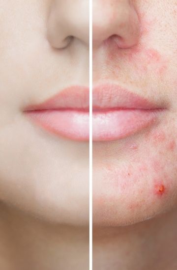 Tratamento de Cicatrizes de Acne